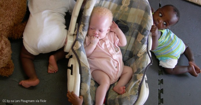 Amnistia Internacional Albinismo